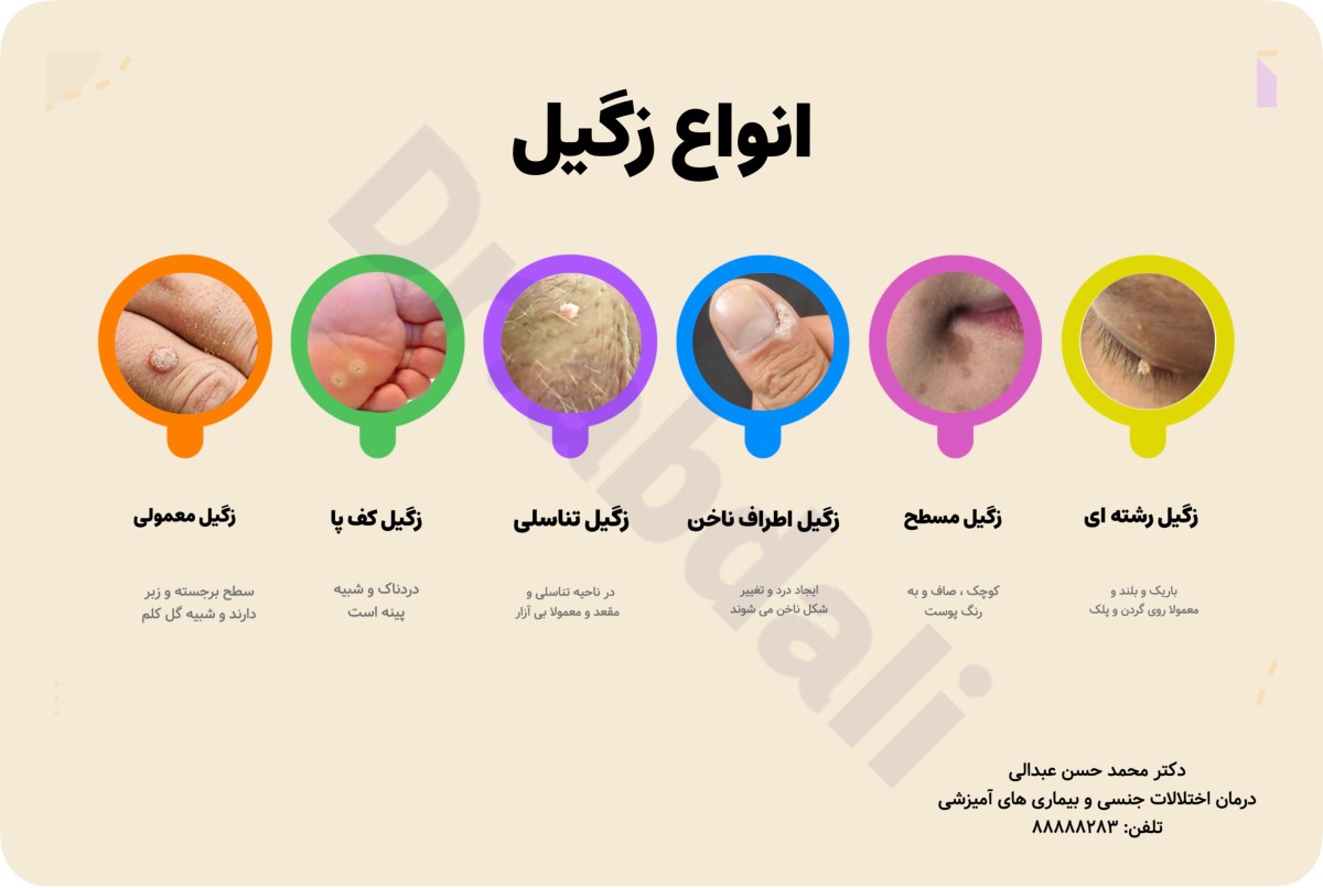 اینفوگرافی انواع زگیل