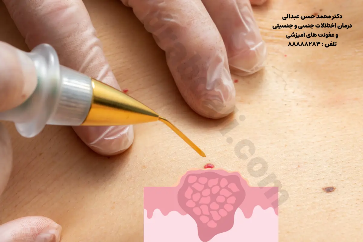 مزایا و معایب کرایو تراپی زگیل تناسلی