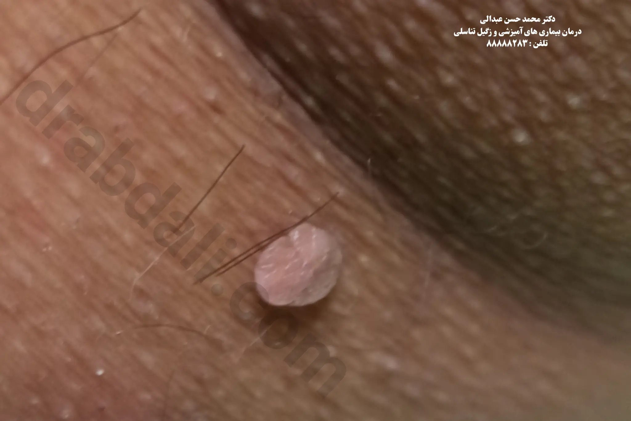 گالری عکس زگیل تناسلی